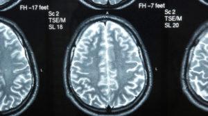 sztuczna inteligencja Alzheimer